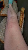 [Bonesmart.org] Knee Scars - Post Your Badges of Honor Here! NO CHIT-CHAT please