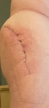 [Bonesmart.org] Hippies scars - post your badges of honor here: NO CHIT-CHAT HERE PLEASE