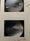 [Bonesmart.org] Recovery Journey Continues