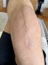 [Bonesmart.org] Knee Scars - Post Your Badges of Honor Here! NO CHIT-CHAT please