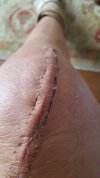 [Bonesmart.org] TKR after tibial plateau fracture
