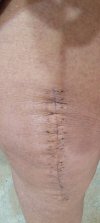 [Bonesmart.org] Knee Scars - Post Your Badges of Honor Here! NO CHIT-CHAT please