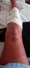 [Bonesmart.org] Awake during surgery