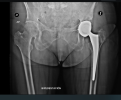 ruth hip device.png