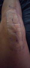 [Bonesmart.org] Start of my knee journey