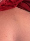 [Bonesmart.org] one week post-op, 39 years old