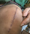 [Bonesmart.org] Days of Recovery (TKR 1/4)