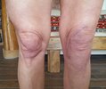 [Bonesmart.org] TKR after tibial plateau fracture