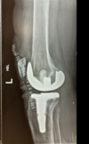 [Bonesmart.org] TKR after tibial plateau fracture