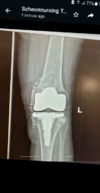 [Bonesmart.org] TKR after tibial plateau fracture