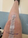 [Bonesmart.org] My solo odyssey to recovery