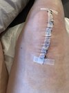 [Bonesmart.org] Two TKRs and a broken kneecap - on the mend now!