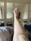 [Bonesmart.org] Two TKRs and a broken kneecap - on the mend now!