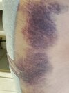 [Bonesmart.org] Partial Revision Failure