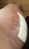 [Bonesmart.org] Hippies scars - post your badges of honor here: NO CHIT-CHAT HERE PLEASE