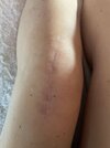 [Bonesmart.org] JusticeRider’s rehab adventure