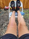[Bonesmart.org] Knee Scars - Post Your Badges of Honor Here! NO CHIT-CHAT please
