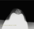 [Bonesmart.org] TKR after tibial plateau fracture