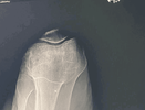[Bonesmart.org] TKR after tibial plateau fracture