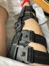 [Bonesmart.org] Two TKRs and a broken kneecap - on the mend now!