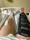 [Bonesmart.org] Two TKRs and a broken kneecap - on the mend now!