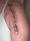 [Bonesmart.org] Shoulder scars - post your badges of honour here: NO CHIT-CHAT HERE PLEASE