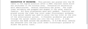 [Bonesmart.org] FAI Surgery Round Two—All Done!