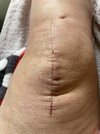 [Bonesmart.org] Knee Scars - Post Your Badges of Honor Here! NO CHIT-CHAT please