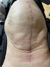 [Bonesmart.org] Knee Scars - Post Your Badges of Honor Here! NO CHIT-CHAT please