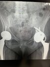 [Bonesmart.org] Complex Revision poor outcome Ehlers Danlos