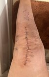 [Bonesmart.org] Knee Scars - Post Your Badges of Honor Here! NO CHIT-CHAT please