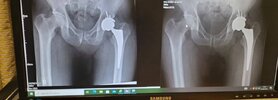 [Bonesmart.org] Spongebob's Recovery Journey