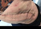 [Bonesmart.org] Hippies scars - post your badges of honor here: NO CHIT-CHAT HERE PLEASE