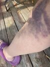 [Bonesmart.org] Back again, 1 and 2 years post op