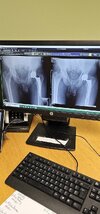 [Bonesmart.org] Spongebob's Recovery Journey