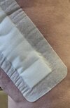 [Bonesmart.org] RTHR at 56 due Avascular Necrosis