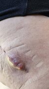 [Bonesmart.org] RTHR at 56 due Avascular Necrosis