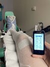 [Bonesmart.org] Limb Salvage Surgery Recovery