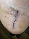 [Bonesmart.org] Hip #2 17 months later