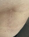 [Bonesmart.org] Hip #2 17 months later