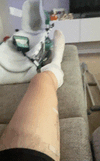 [Bonesmart.org] Limb Salvage Surgery Recovery