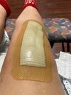 [Bonesmart.org] Second Knee Replacement Done