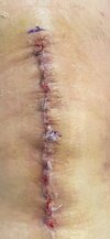 [Bonesmart.org] Second Knee Replacement Done