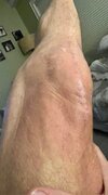 [Bonesmart.org] Nolander's LPKR Recovery Thread
