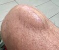 [Bonesmart.org] Nolander's LPKR Recovery Thread