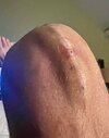[Bonesmart.org] Nolander's LPKR Recovery Thread