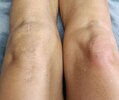 [Bonesmart.org] Knee Scars - Post Your Badges of Honor Here! NO CHIT-CHAT please