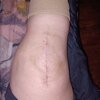[Bonesmart.org] Knee Scars - Post Your Badges of Honor Here! NO CHIT-CHAT please