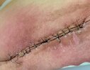[Bonesmart.org] Complex surgery with revisions, infection, sepsis, and more…