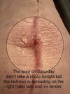 [Bonesmart.org] Post-op Spasms